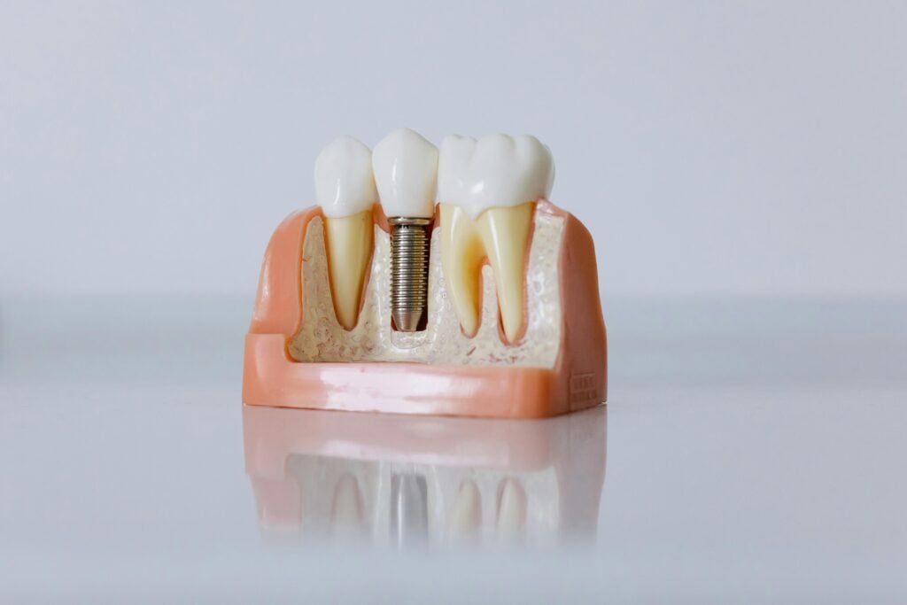 dental implant fatigue study
